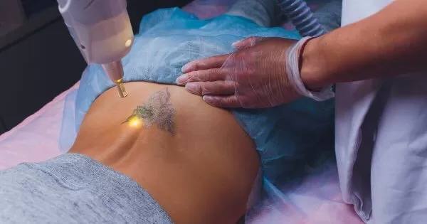 Laser Tattoo Removal Carmel Indiana Spa