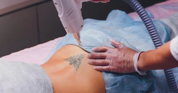 Laser Tattoo Removal  Highland IN N Hasan MD Medical Spa Cosmetico  MedSpa
