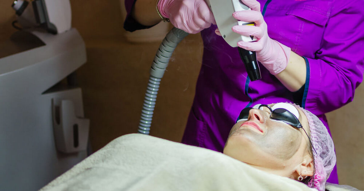 Laser Carbon Peel Treatment Carmel Indiana B