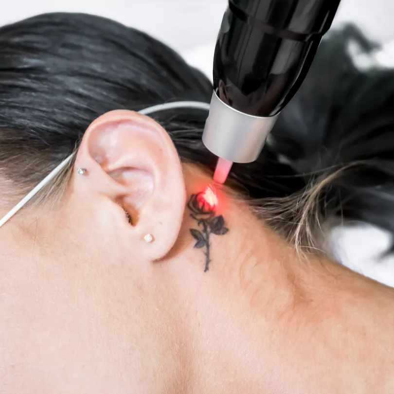 Laser Tattoo Removal 1