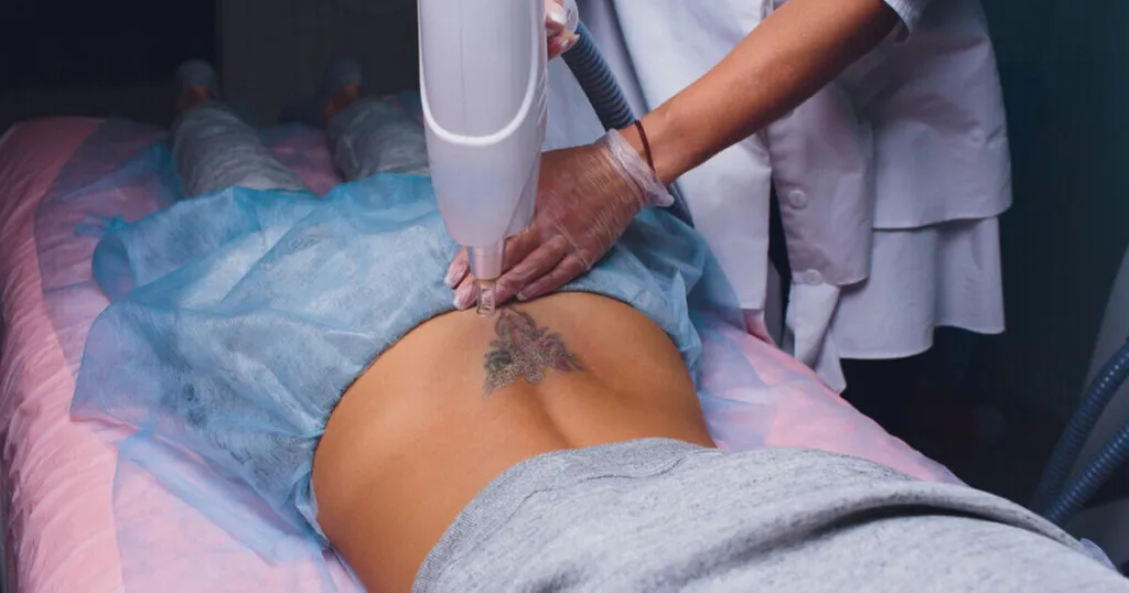 Laser Tattoo Removal A 1200 Tin