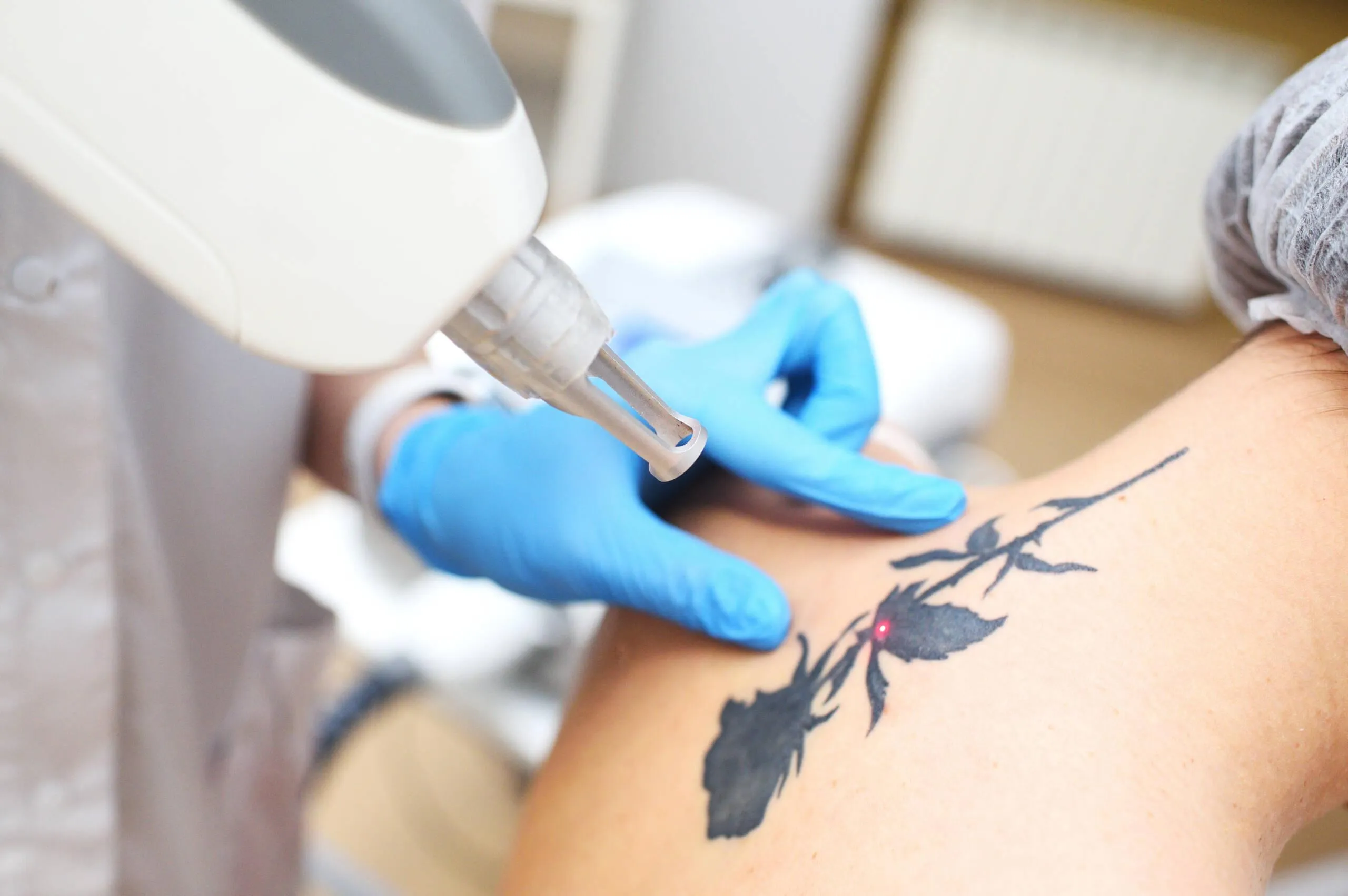 removes the tattoo